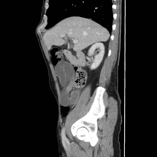 Closed loop small bowel obstruction (Radiopaedia 59227-66554 C 20).jpg