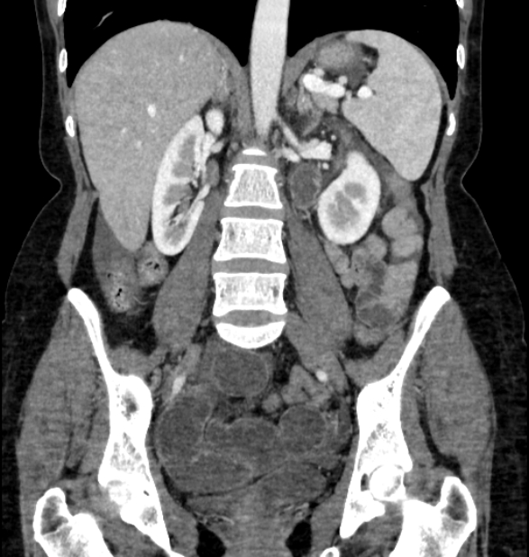 Closed loop small bowel obstruction (Radiopaedia 71211-81508 B 74).jpg