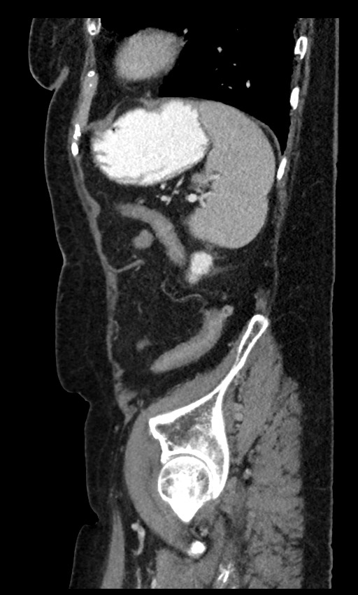 Closed loop small bowel obstruction - adhesions (Radiopaedia 59269-66611 C 26).jpg