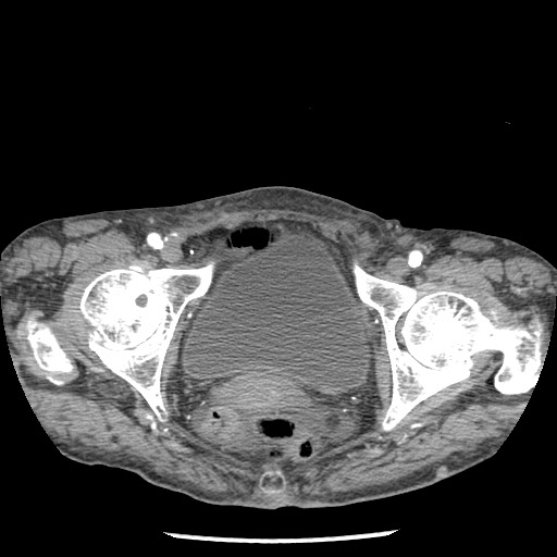 Closed loop small bowel obstruction - adhesions and infarct (Radiopaedia 85125-100678 A 194).jpg