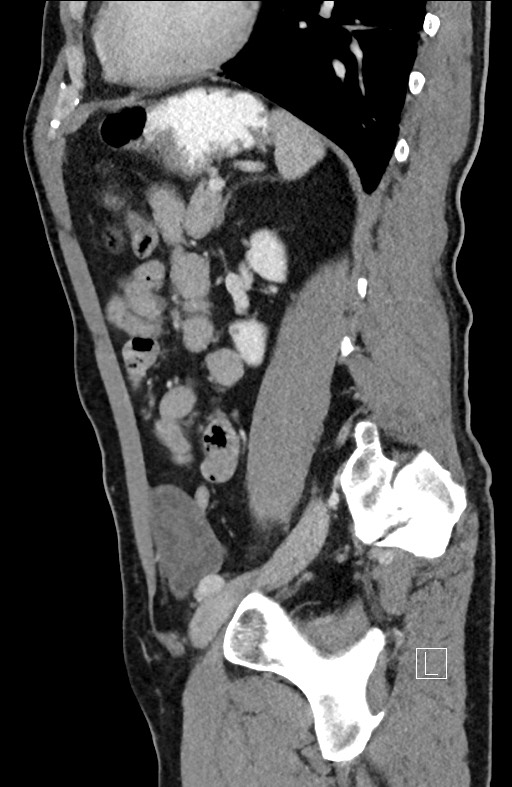 Closed loop small bowel obstruction - internal hernia (Radiopaedia 57806-64778 C 40).jpg