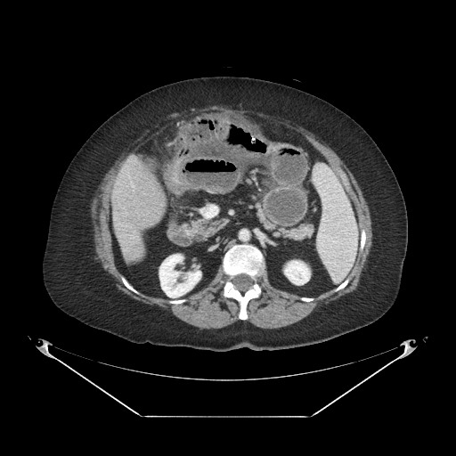 File:Closed loop small bowel obstruction - internal hernia (Radiopaedia 65402-74450 A 47).jpg