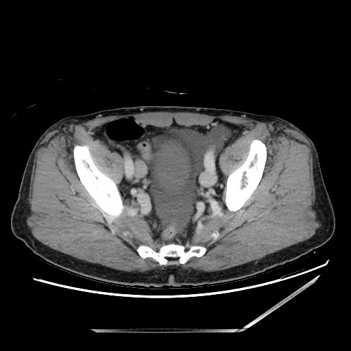 Closed loop small bowel obstruction - omental adhesion causing "internal hernia" (Radiopaedia 85129-100682 A 142).jpg