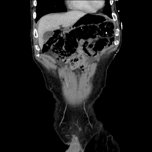 Closed loop small bowel obstruction - omental adhesion causing "internal hernia" (Radiopaedia 85129-100682 B 34).jpg