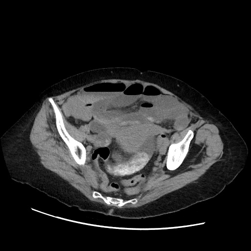 File:Closed loop small bowel obstruction due to adhesive band, with intramural hemorrhage and ischemia (Radiopaedia 83831-99017 Axial non-contrast 130).jpg