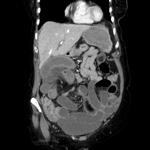File:Closed loop small bowel obstruction due to adhesive band, with intramural hemorrhage and ischemia (Radiopaedia 83831-99017 C 41).jpg