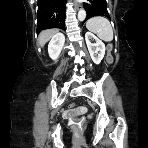 Closed loop small bowel obstruction due to adhesive band, with intramural hemorrhage and ischemia (Radiopaedia 83831-99017 C 89).jpg
