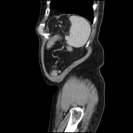 Closed loop small bowel obstruction due to adhesive band - U-shaped loop (Radiopaedia 83829-99012 C 12).jpg