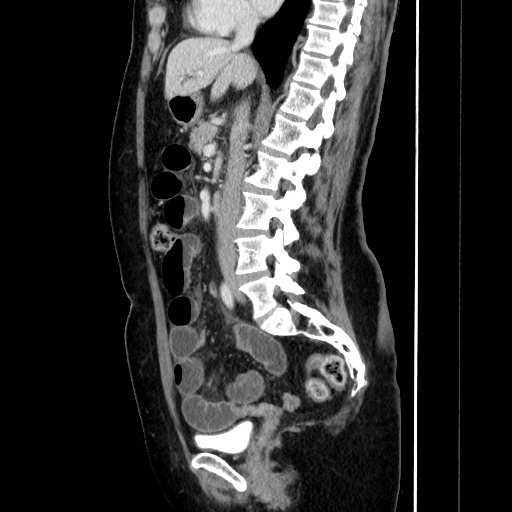 Closed loop small bowel obstruction due to adhesive bands - early and late images (Radiopaedia 83830-99015 C 86).jpg