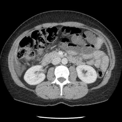 File:Closed loop small bowel obstruction due to trans-omental herniation (Radiopaedia 35593-37109 A 39).jpg