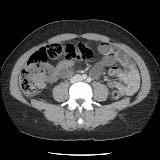 File:Closed loop small bowel obstruction due to trans-omental herniation (Radiopaedia 35593-37109 A 50).jpg