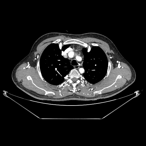 Coarctation of aorta (Radiopaedia 25384-25630 A 32).jpg