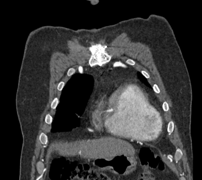 Coarctation of the aorta (Radiopaedia 53752-59822 B 16).jpg