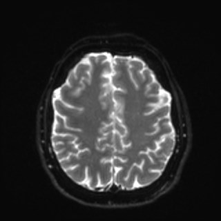 File:Cochlear incomplete partition type III associated with hypothalamic hamartoma (Radiopaedia 88756-105498 Axial DWI 30).jpg