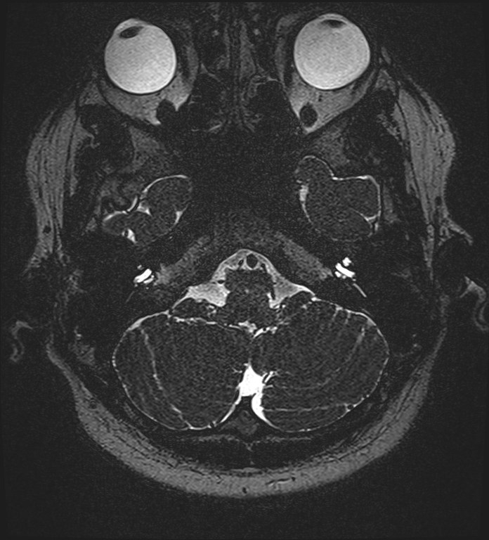 Cochlear incomplete partition type III associated with hypothalamic hamartoma (Radiopaedia 88756-105498 Axial T2 55).jpg