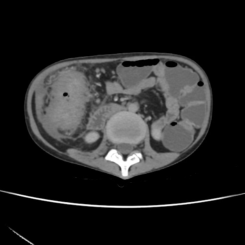 File:Colocolic fistula - Crohn disease (Radiopaedia 57063-63955 A 36).jpg