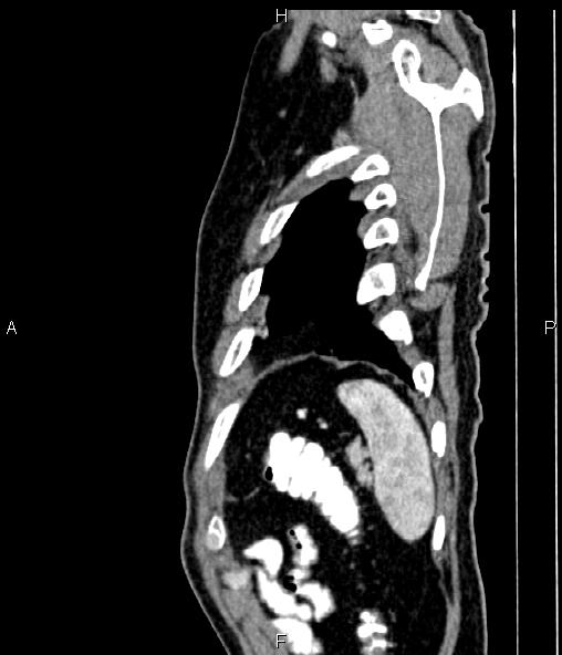 Colon adenocarcinoma (Radiopaedia 83266-97671 D 96).jpg