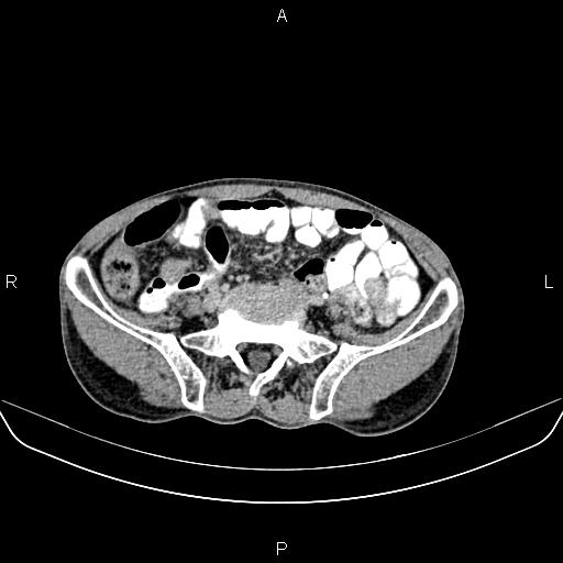 File:Colon adenocarcinoma - hepatic flexure (Radiopaedia 85635-101395 Axial C+ delayed 66).jpg
