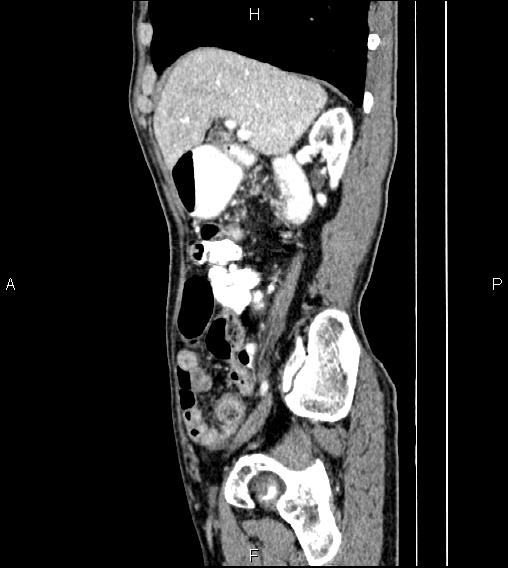 Colon adenocarcinoma - hepatic flexure (Radiopaedia 85635-101395 D 27).jpg