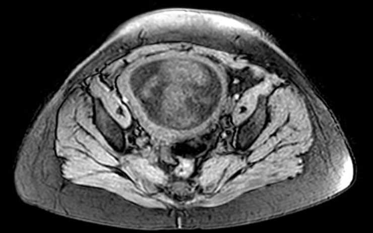 Colon adenocarcinoma with Krukenberg tumors, advanced pregnancy (Radiopaedia 67279-76645 A 19).jpg