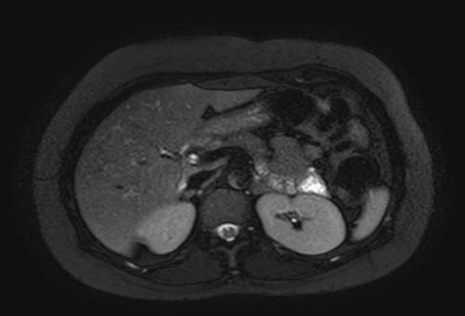 Colon adenocarcinoma with Krukenberg tumors, advanced pregnancy (Radiopaedia 67279-76645 Axial T2 SPAIR 60).jpg