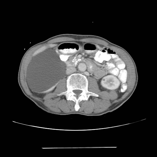 Colon cancer with calcified liver metastasis (Radiopaedia 74423-85307 A 35).jpg