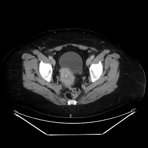 File:Colonic intussusception due to adenocarcinoma (Radiopaedia 86828-102987 A 132).jpg
