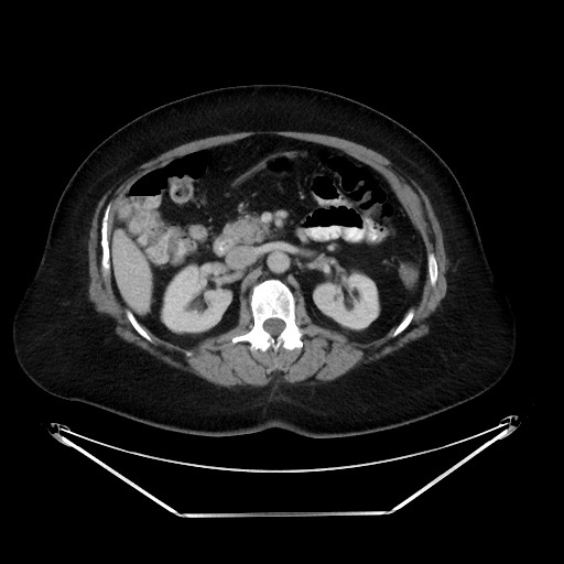 File:Colonic intussusception due to adenocarcinoma (Radiopaedia 86828-102987 A 59).jpg