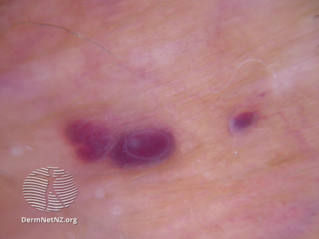 File:Dermoscopy of angiokeratoma of Fordyce on vulva (DermNet NZ angiokeratoma-51).jpg