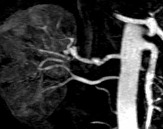 File:Fibromuscular dysplasia of a duplicated renal artery (Radiopaedia 14346).jpg