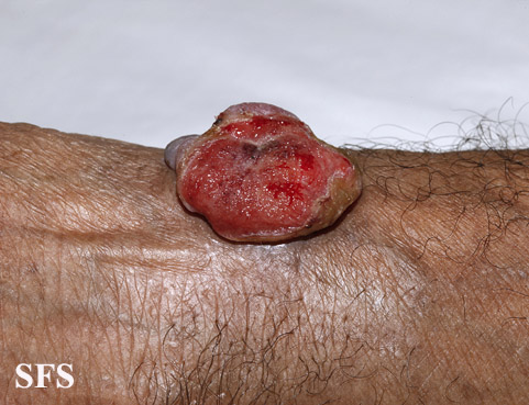 File:Melanoma (Dermatology Atlas 53).jpg