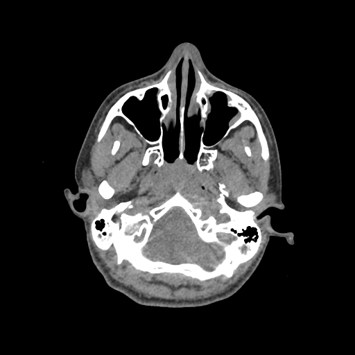 Nasal pyogenic granuloma (lobular capillary hemangioma) (Radiopaedia 85536-101244 Axial non-contrast 54).jpg