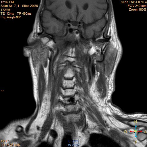 File:Nasopharyngeal carcinoma (Radiopaedia 22375-22403 Coronal T1 11).jpg