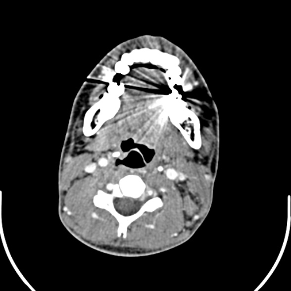Nasopharyngeal carcinoma with skull base invasion (Radiopaedia 53415-59705 A 113).jpg