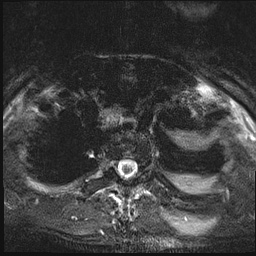 File:Nasopharyngeal carcinoma with skull base invasion (Radiopaedia 59258-66600 Axial T2 fat sat 22).jpg
