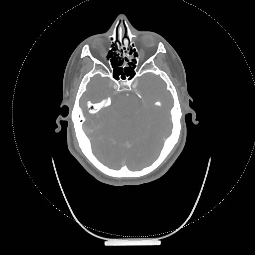 Neck CT angiogram (intraosseous vascular access) (Radiopaedia 55481-61945 B 283).jpg