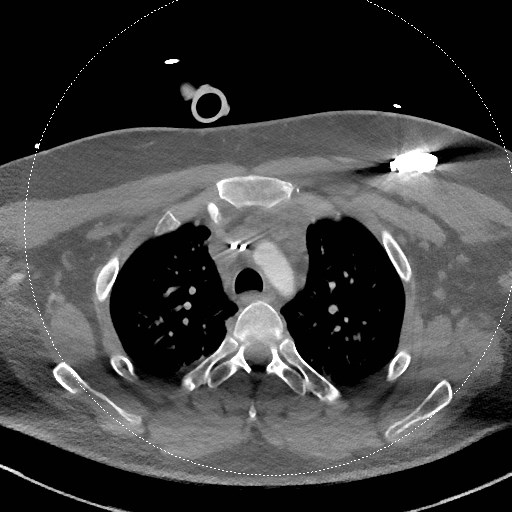 Neck CT angiogram (intraosseous vascular access) (Radiopaedia 55481-61945 B 60).jpg
