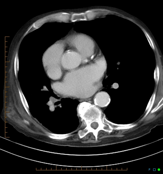 Necrotzing fasciitis due to a perforated adenocarcinoma of the splenic flexure (Radiopaedia 46930-51455 A 5).jpg