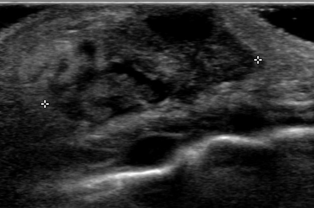 File:Neonatal mastitis with abscess (Radiopaedia 47089-51629 Longitudinal 1).jpg