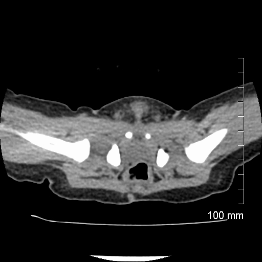 File:Neonatal neuroblastoma (Radiopaedia 56651-63438 Axial non-contrast 81).jpg