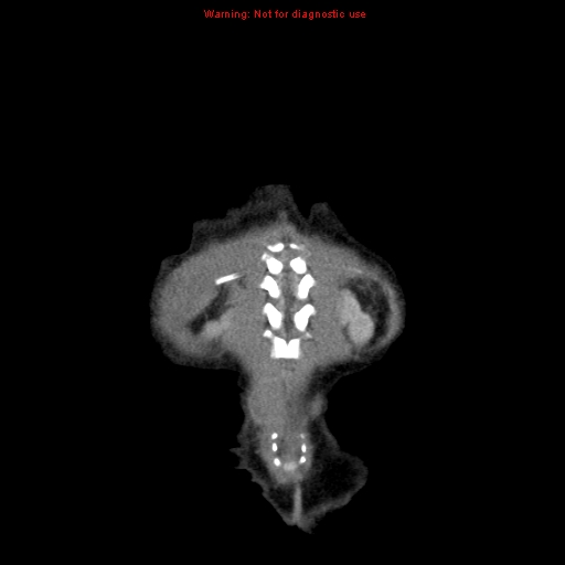 File:Neonatal neuroblastoma (Radiopaedia 9564-10223 B 106).jpg