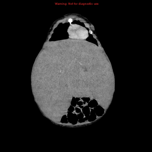 File:Neonatal neuroblastoma (Radiopaedia 9564-10223 B 34).jpg