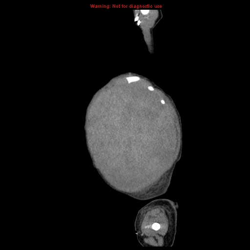 File:Neonatal neuroblastoma (Radiopaedia 9564-10223 C 16).jpg