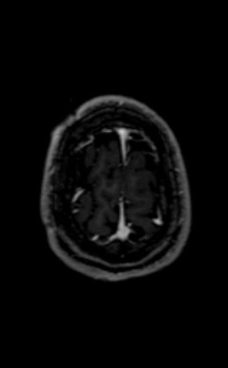 Neuro-Behçet disease (Radiopaedia 90112-107294 Axial T1 C+ 60).jpg