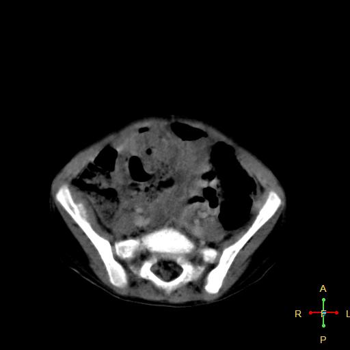 File:Neuroblastoma (Radiopaedia 24751-25016 D 31).jpg