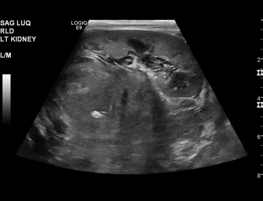 Neuroblastoma (Radiopaedia 47939-52718 Cine Clip 26).jpg