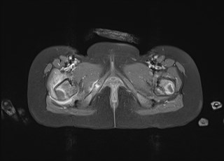 File:Neuroblastoma with bone metastases (Radiopaedia 67080-76414 Axial T1 C+ fat sat 42).jpg