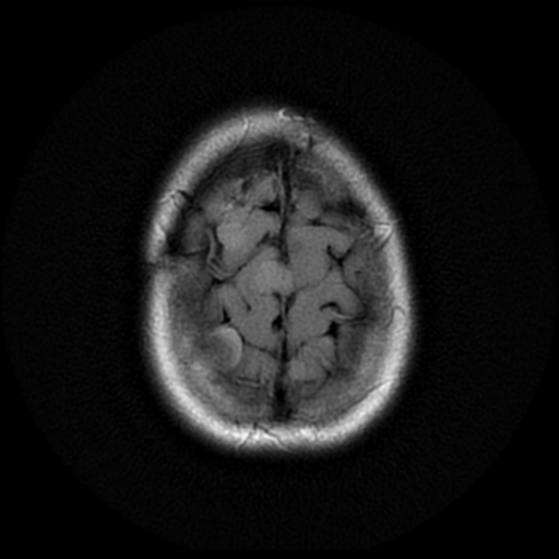 File:Neurofibromatosis type 2 (Radiopaedia 45229-49244 Axial FLAIR 19).png