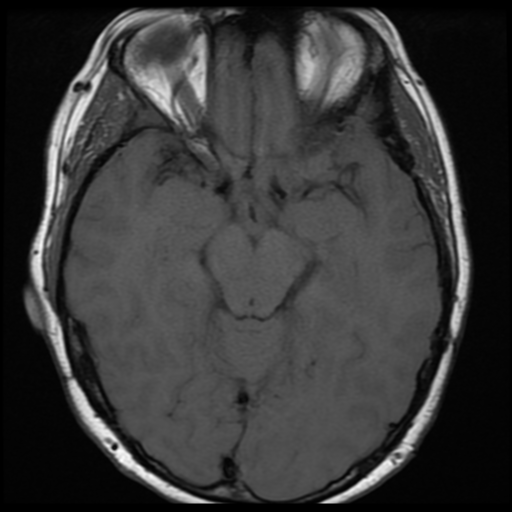 File:Neurofibromatosis type 2 (Radiopaedia 45229-49251 Axial T1 15).png