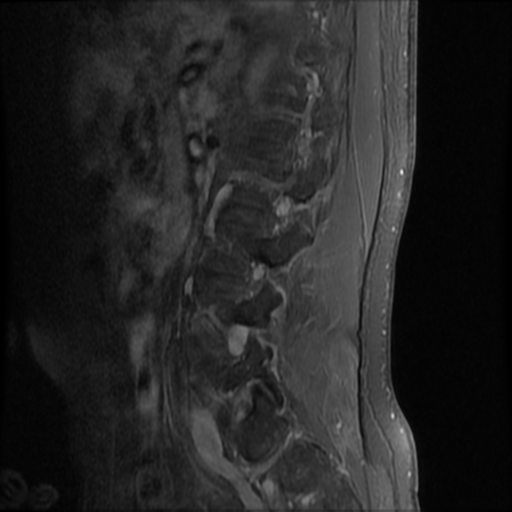 File:Neurofibromatosis type 2 (spinal manifestations) (Radiopaedia 53943-60070 K 3).png